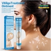 KEM BÔI BẠCH BIẾN LANG BEN VITILIGO SOUTH MOON-20GR [CHUẨN 100% HÀNG CTY]-TRỊ MỜ BẠCH BIẾN ĐỐM TRẮNG NÁM THÂM HIỆU QUẢ