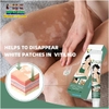 KEM BÔI BẠCH BIẾN LANG BEN VITILIGO SOUTH MOON-20GR [CHUẨN 100% HÀNG CTY]-TRỊ MỜ BẠCH BIẾN ĐỐM TRẮNG NÁM THÂM HIỆU QUẢ