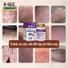 KEM BÔI DA LIỄU NAKUSA ĐẾN TỪ NHẬT BẢN HŨ 55GR- CHUYÊN TRỊ NẤM NGỨA, HẮC LÀO TỔ ĐỈA, GHẺ, Á SỪNG, DỊ ỨNG, MỀ ĐAY, VIÊM DA CƠ ĐỊA 