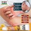 KEM BÔI NỌC ONG ĐẶC TRỊ NẤM NGỨA, MỤN NƯỚC HBESTY 20GR- CHO DA VIÊM, CHÀM ECZEMA,TỔ ĐỈA, VẨY NẾN Á SỪNG