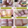 KEM BÔI KHÁNG KHUẨN ĐẶC TRỊ NẤM NGỨA, NẤM MÓNG TAY CHÂN BỌ CẠP ĐEN 15GR- NỘI ĐỊA TRUNG [CHUẨN 100% HÀNG CTY]