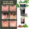 KEM KHÁNG KHUẨN TRỊ NẤM NGỨA VẨY NẾN Á SỪNG EBORRHEIC DERMATITIS- SUMIFUN 20GR- ĐẶC TRỊ NẤM ĐẦU GÀU NGỨA, VIÊM DA TIẾT BÃ CHĂM SÓC DA TOÀN THÂN
