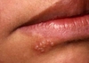 Gel trị tróc mép Herpes và zona thần kinh SOS Lippenherpes