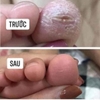 KEM KERATINAMIN - ĐẶC TRI Á SỪNG