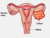 CA 125: DẤU ẤN UNG THƯ BUỒNG TRỨNG