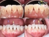 Khuôn Trám Trong Suốt E-clear MATRIX – Giải Pháp Tạo Hình Răng Chuẩn Xác, Thẩm Mỹ Cao