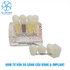 Mô hình tư vấn So sánh Implant và cầu răng