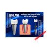 Tranh Implant nha khoa- MS22