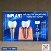 Tranh Implant nha khoa- MS22
