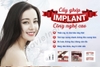 Tranh cấy ghép Implant công nghệ cao