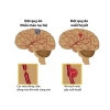 10 Dấu Hiệu Tai Biến Mạch Máu Não