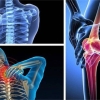 11 cách để giảm nguy cơ mắc viêm xương khớp