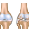9 yếu tố dễ gây thoái hóa khớp
