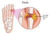 Dấu hiệu và triệu chứng bệnh gout