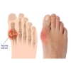 5 biến chứng nguy hiểm của bệnh gout