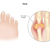 Biểu hiện thường gặp của bệnh gout cấp và cách xử trí