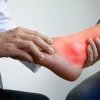 BÙNG PHÁT CƠN GOUT CẤP MÙA DU LỊCH