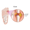 Dấu Hiệu Và Triệu Chứng Bệnh Gout