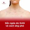 Sẩn ngứa do gan và cách ứng phó