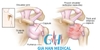 Siêu âm trị liệu trong điều trị cứng <br>khớp vai do viêm dính bao khớp vai
