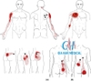 Siêu âm trị liệu trong điều trị <br>hội chứng đau cân cơ