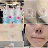 Miếng dán kháng khuẩn mụn và giảm đỏ Olive Young Care Plus Scar Cover Spot Patch 102 miếng