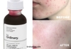 Tinh Chất Tẩy Da Chết Hoá Học The Ordinary AHA 30% + BHA 2% Peeling Solution 30ml