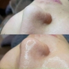 Ủ Mũi Xử Lý Mụn Removes Blackheads