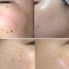 Kem trị nám cao cấp Dongsung Rannce Cream.