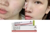 Tretinoin Ngừa Mụn Và Chống Lão Hóa Gel USP Aret 0.1% Menarini (Tretinoin Ấn Độ)