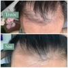 Xịt mọc tóc, ngừa rụng tóc Minoxidil 5% Bailleul (1 hộp 3 lọ 60ml*3)