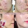 Kem tretinoin tái tạo hỗ trợ trị mụn, mờ nám Abdi Ibrahim Acnelyse Krem Tretinoin % 0.1