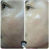 Tinh chất trắng da, trị nám, tàn nhang Dr. Gene Vita Pepta C Pi.Gene (Vitamin C)