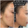 Tinh Chất Lumos Acne Hỗ Trợ Giảm Mụn, Giảm Dầu Nhờn (có hóa đơn VAT)