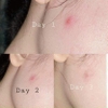 Tinh Chất Lumos Acne Hỗ Trợ Giảm Mụn, Giảm Dầu Nhờn (có hóa đơn VAT)