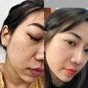 Huyết thanh đặc trị nám, phân giải sắc tố Meline 02 Caucasian Skin Day 