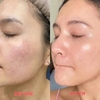 Siêu Tinh Chất Sáng Da, Giảm Thâm Nám Angel's Liquid Tranexamic Mela Zero Ampoule 30ml