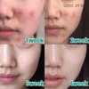 Bộ Dùng Thử Trị Mụn Some By Mi AHA- BHA-PHA 30 Days Miracle Set (4 Sản Phẩm) (Dùng được trong vừa vặn 30 ngày)