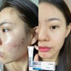 Gel ngừa mụn trứng cá, ngừa thâm, mờ sẹo, dưỡng da  Derma Forte Advanced tuýp 15g
