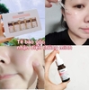 Tinh Chất Trắng Da, Trị Nám Honesi Vita Peel Brightening Ampoule