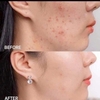 Tinh Chất Hỗ Trợ Giảm Mụn Và Giảm Dầu Thừa Trên Da Ekseption Hyaluronic Znpca Mixlab Serum 75ml