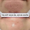 Dung dịch, toner BHA giảm mụn, nhờn, sáng da Obagi CLENZIderm Pore Therapy