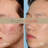 Siêu Tinh Chất Sáng Da, Giảm Thâm Nám Angel's Liquid Tranexamic Mela Zero Ampoule 30ml