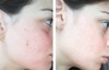 Serum trị mụn và thâm, làm trắng da The Ordinary Niacinamide 10% + Zinc 1%