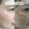 Kem đặc trị nám Melanopeel Cream