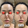 Peel tái tạo da chuyên sâu, cho da mụn nám tàn nhang và LCL to CNP Rx Skin Rejuvenating Intensive Peel 2ml 