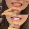 Kem đánh răng Median Dental IQ White 93% new Hàn Quốc (có VAT)