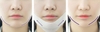 Mặt Nạ V-Line Missha Lifting Patch ( Giúp gương mặt thon gọn )