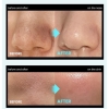 Set Tinh Chất Ủ Mụn Đầu Đen Ilso Sebum Super Melting Serum Softener 150g (PHIÊN BẢN LIMITED)