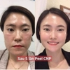 Peel tái tạo da chuyên sâu, cho da mụn nám tàn nhang và LCL to CNP Rx Skin Rejuvenating Intensive Peel 2ml 